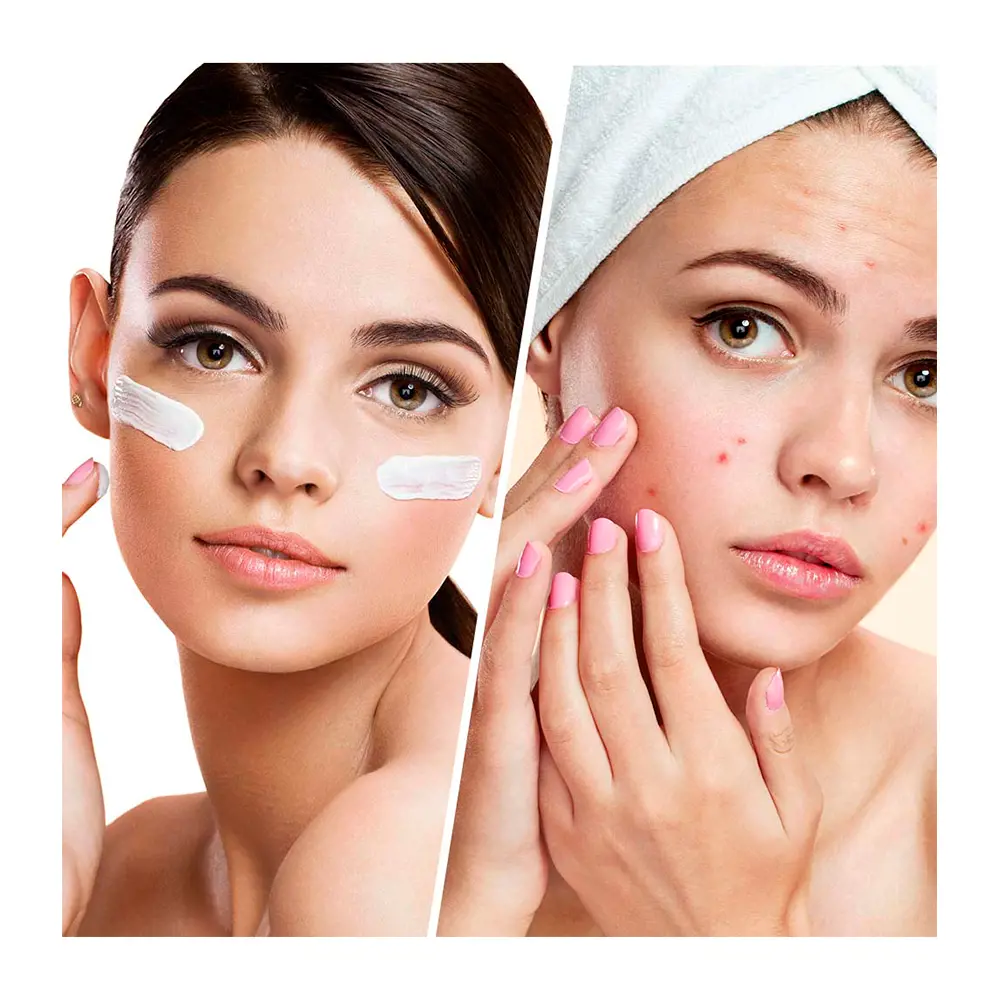 Biovene BLEMISH CONTROL clear complexion facial moisturizer l... 3 Biovene BLEMISH CONTROL clear complexion facial moisturizer l... Kem điều trị mụn