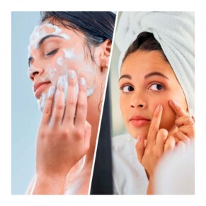Biovene SALICYCLIC SUPER CLEANSER face & body blackhead + bre... Kem dưỡng ẩm Điều trị mụn trứng cá & loại bỏ đầu đen
